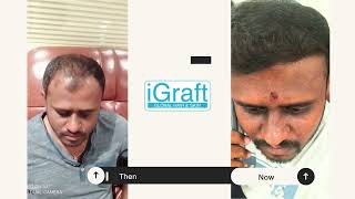 Miraculous Hair Regrowth with iGraft GFC  BioCell Treatment  Mr Narayans Transformation Story [upl. by Anitap]