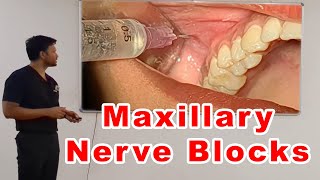 Maxillary Nerve Blocks Lecture  Dr Zibran Khan [upl. by Lamp21]