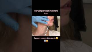 Dermal Filler Cannula Method for Fillers For Marionette lines  Happy Hands Aesthetics [upl. by Htidirrem809]