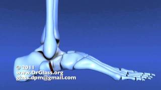 Evans Calcaneal Osteotomy of the Flat Foot [upl. by Kcirederf158]