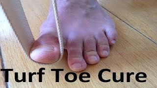 Turf Toe Treatment 1 Min Home Remedy [upl. by Teak]