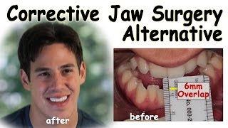 Corrective Jaw Surgery Alternative  Underbite Correction without Surgery [upl. by Greenland]