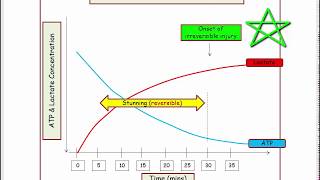 12DaysinMarch ASHD4 Cardiac Pathology of Myocardial Infarction for the USMLE Step One Exam [upl. by Enirahtak]