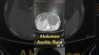 Abdomen ascitic fluid abdomen abdomenascitic shorts viralshorts [upl. by Turley]