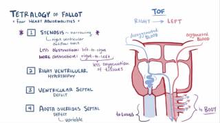 Tetralogy of fallot TOF repair causes symptoms amp pathology [upl. by Consalve23]