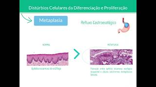 Metaplasia e Displasia  Patologia [upl. by Aitnwahs]