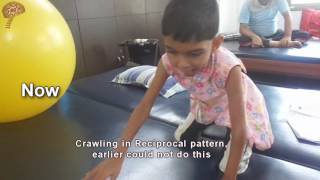 Spastic Quadriplegic Cerebral Palsy Treatment Results  Quick Look  No 3413 [upl. by Neema767]