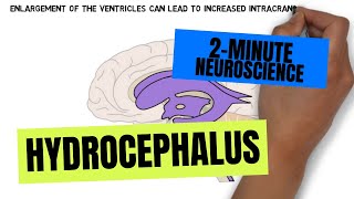 2Minute Neuroscience Hydrocephalus [upl. by Daitzman548]