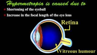 Hypermetropia or Hyperopia [upl. by Dolorita]