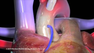 Coronary Artery Bypass Grafting CABG [upl. by Ravel]