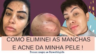 COMO ELIMINEI AS MANCHAS E ACNE DA MINHA PELE [upl. by Grobe]