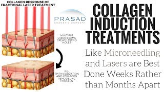 Why Collagen Induction Treatments Like Microneedling are Best Spaced Weeks Rather than Months Apart [upl. by Kaela]