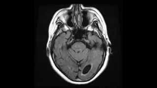 Periventricular leukomalacia Axial T2 FLAIR [upl. by Aiva]