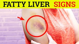 10 Silent Signs Of Fatty Liver  Early Symptoms Of Fatty Liver Disease [upl. by Salvador]