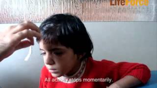 Video of Child with Petit Mal Epilepsy Attack Induced by Exertion Physical Effort [upl. by Lorna]