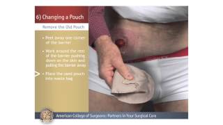 ColostomyIleostomy Changing a Pouch [upl. by Eido]