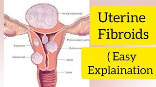 Uterine fibroids In hindi  Easy explaination   Type of fibroids [upl. by Meghan]