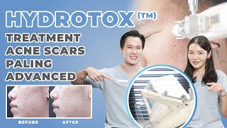 UPDATE ACNE SCARS TREATMENT METODE PALING ADVANCED  QampA Part 1  Injectables [upl. by Ten]