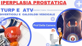 Turp  resezione transuretrale prostatica e atv Calcolosi vescicale e diverticoli le complicanze [upl. by Aisorbma]