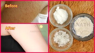 How to Get Rid of Tiny Red Bumps Rashes from Face Arms Hips  Chicken Skin Treatment [upl. by Tteragram]