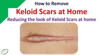 How to Remove Keloid Scars at Home  Reducing the look of Keloid Scars at home [upl. by Krueger]