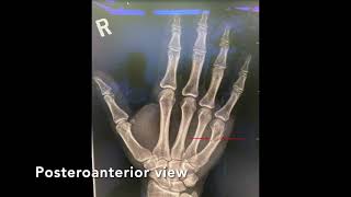 Boxers Fracture Overview in 2 minutes [upl. by Zobe]