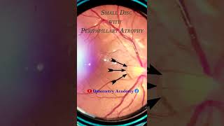 Small disc with peripappilary atrophy  Smartphone Fundus Videography  Fundus  Short Video 67 [upl. by Layol377]