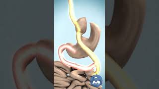 Procedimiento  Bypass Gastrico [upl. by Delly]