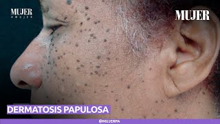 Dermatosis papulosa nigra  Mujer [upl. by Aneeras]