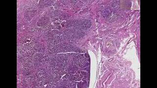 Histopathology LiverPrimary biliary cirrhosis [upl. by Chor759]