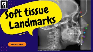 Lateral cephalogram x ray  Lateral cephalogram x ray anatomy  Soft tissu landmark [upl. by Wright493]