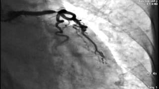 Distal LMCA Bifurcation stenting [upl. by Aiym]