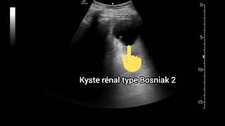 Kyste rénal Type Bosniak 2 Échographie [upl. by Harty464]