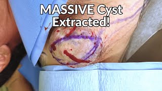 skibidi toilet rizzler gyatt and the BIGGEST cyst extraction [upl. by Eiramnna]