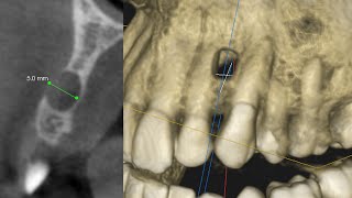 An Asymptomatic Odontogenic ToothRelated Cyst Surgical and Endodontic Management [upl. by Malarkey]