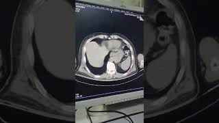 Retroperitoneal cyst [upl. by Vivianne]