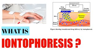 Iontophoresis Electrotherapy [upl. by Ydniahs]