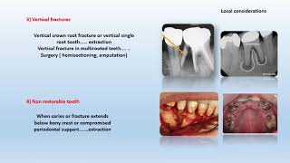 Fall 2020  Endodontic 3  Lec 2  case selection amp ttt plan Part 1 [upl. by Hilde152]