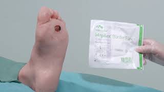 Mepilex Border Flex  Application on Foot [upl. by Nirrek97]