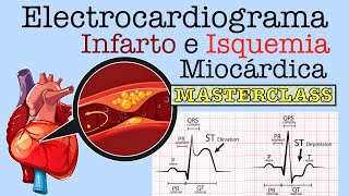 Electrocardiograma Infarto e Isquemia Miocárdica [upl. by Ashelman]