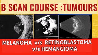 Bscan course  Differentiating choroidal melanoma from retinoblastoma and choroidal hemangioma [upl. by Copland382]