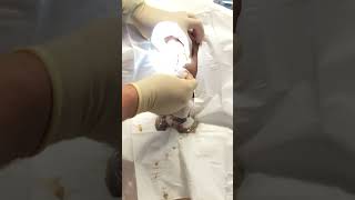 Exploding grapefruit sized sebaceous cyst popping [upl. by Hilel]