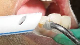 Aquacut Velopex Fluid Abrasion in ClassV cavities [upl. by Kowatch]