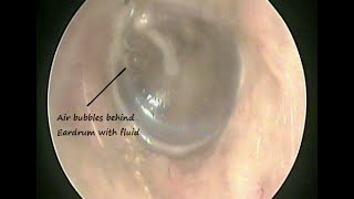 Oto endoscopy  Otitis media with effusion due cold amp allergy [upl. by Yevreh]