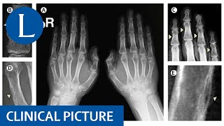 Hyperparathyroidism shows its hand findings of osteitis fibrosa cystica [upl. by Smoot]