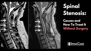 Spinal Stenosis Causes and How to Treat It Without Surgery [upl. by Salvador]