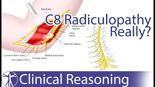 Ulnar Nerve Entrapment mimicking C8 Radiculopathy [upl. by Pearson]