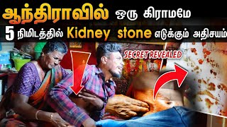 கிட்னி கல் எடுத்தல் இதன் உண்மை வெளியானது  kidney Stone treatment in Tamil  Edison vlogs tamil [upl. by Samara]