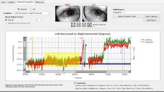 Jerk Nystagmus Gazelab [upl. by Oinimreh]