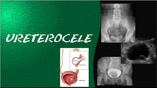 Videoaula e dicas em RADIOLOGIA  ultrassonografia urografia excretora e cistografia  Ureterocele [upl. by Lear]